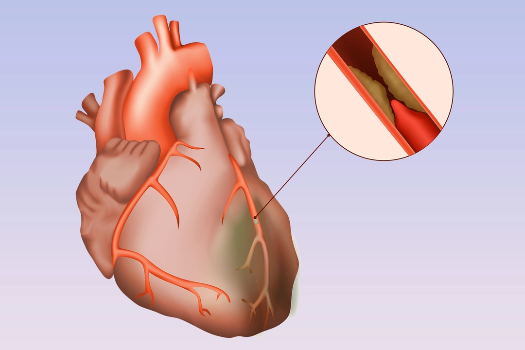 Moxifloxacin and the Heart: Potential Cardiac Risks